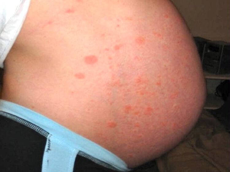 Skin Rash (PUPPP) During Pregnancy - How to recover ...