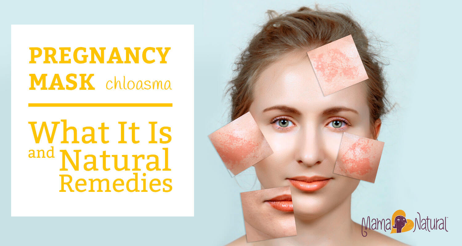 Pregnancy Mask (Chloasma): What It Is &amp; Natural Remedies