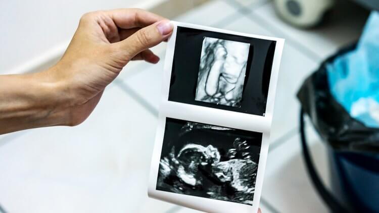 What's the deal with those 3D and 4D ultrasounds popping up? Learn all about the different types of ultrasounds, plus find out whether or not they're safe.