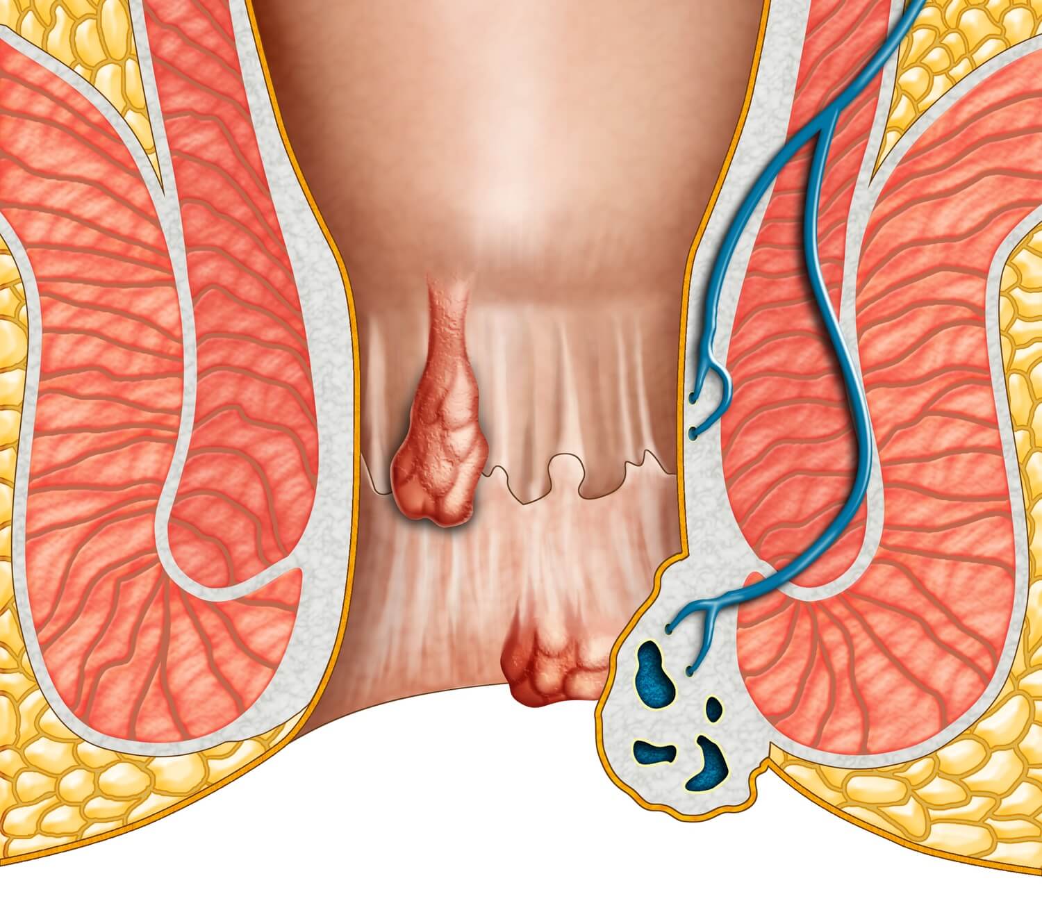 Anatomical drawing showing internal and external hemorrhoids. Digital illustration.