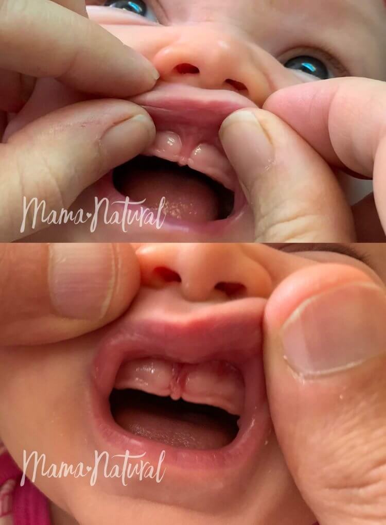 Lip Tie in Babies: Effects, Correction, Feeding Help