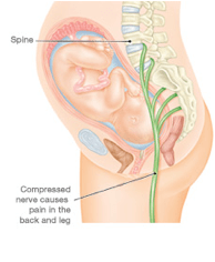 Baby Pressing on Sciatic Nerve