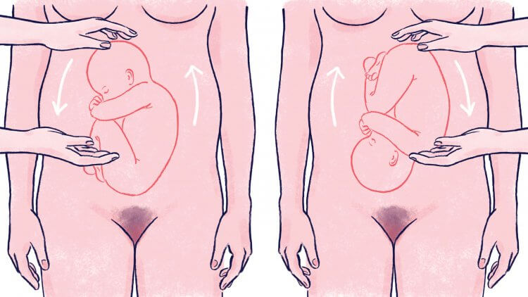 Here's how to turn your breech baby naturally and safely with 8 proven techniques. Flipping a breech baby is your best chance for a natural birth.