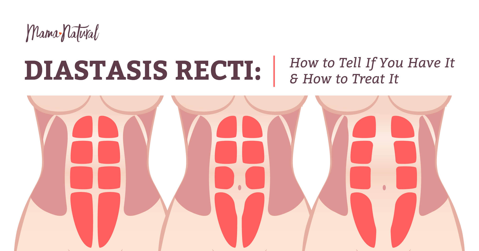 Diastasis Recti Do You Have It Plus How To Treat It