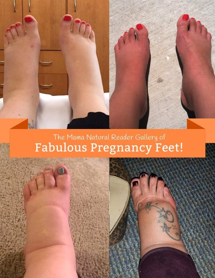 Swollen Feet During Pregnancy Natural Remedies