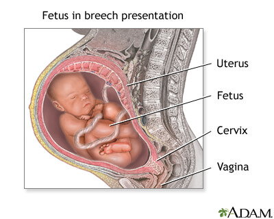 Is Baby In A Breech Position How To Tell What To Do