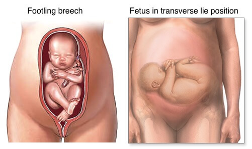 Is Baby In A Breech Position How To Tell What To Do