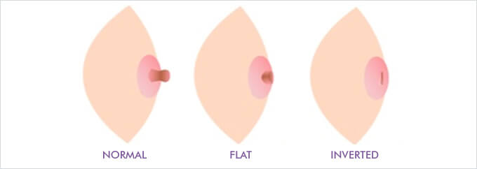 What is an inverted nipple? Difference between inverted, flat, and regular nipples.