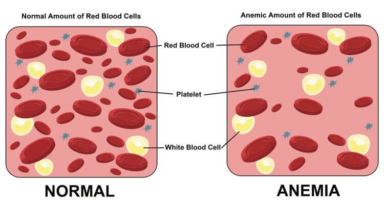 Anemia during pregnancy is common, even for the most health conscious natural mamas. Here are natural solutions to help you restore your health.