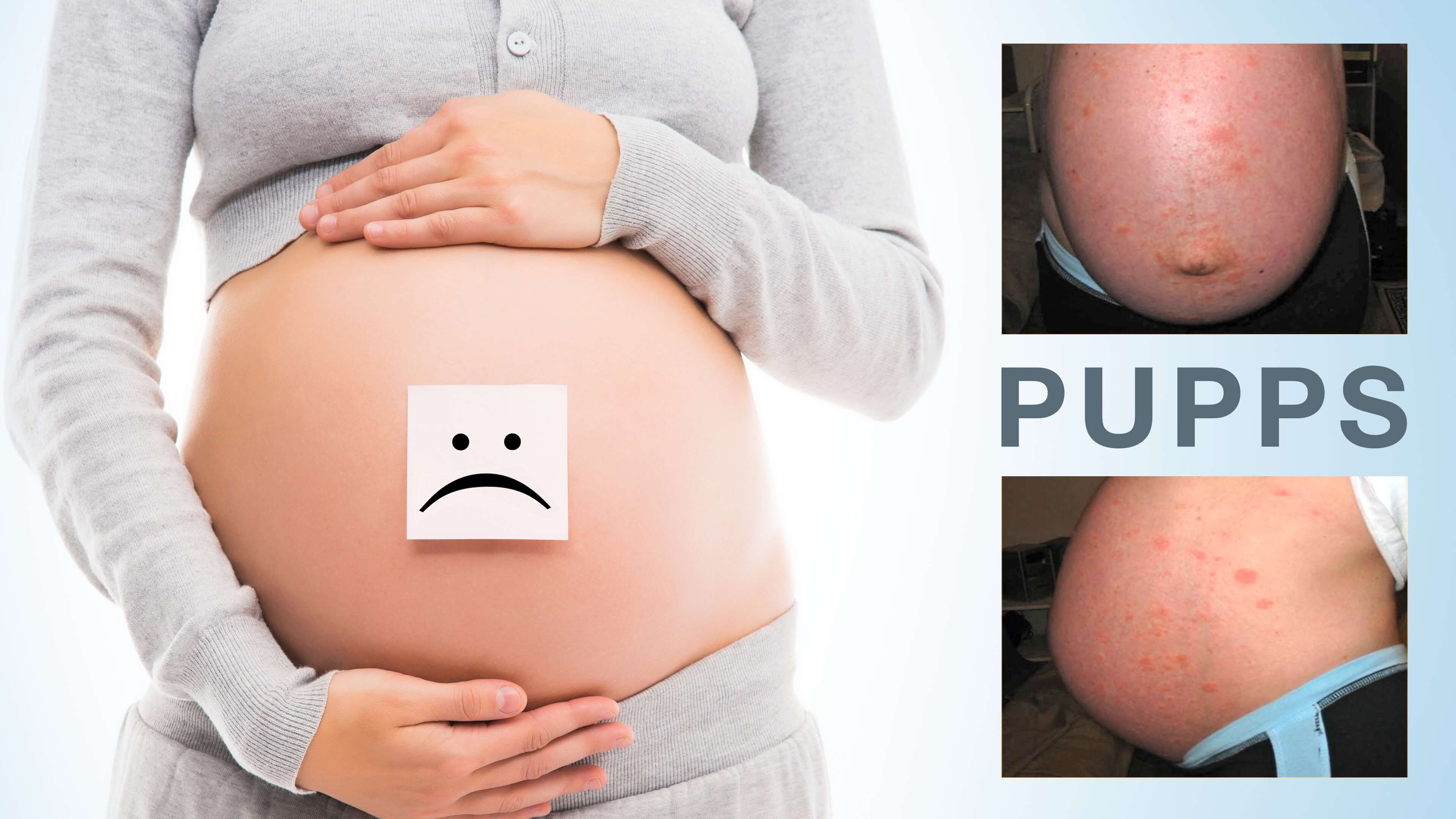 PUPPS Rash in Pregnancy—Natural Treatments