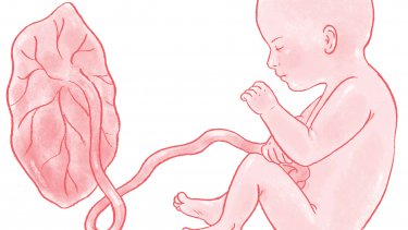 Placenta Accreta: What You Need to Know