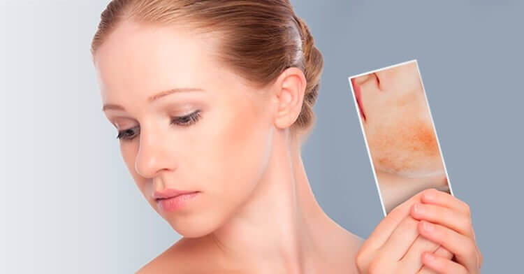 Pregnancy Acne Natural Remedies