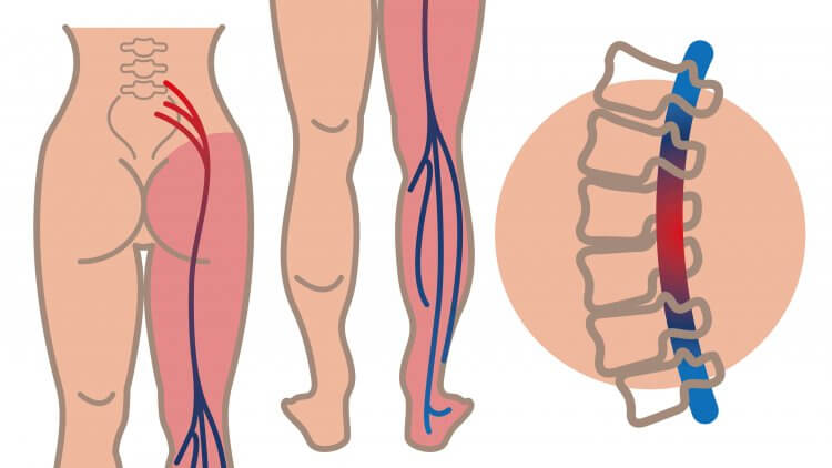 5 Best Home Remedies To Ease Sciatica Pain