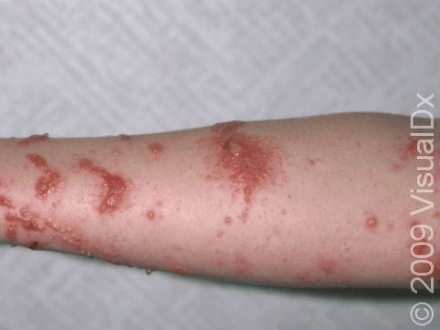 Severe poison ivy rash