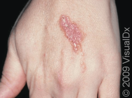 Blistering poison ivy rash