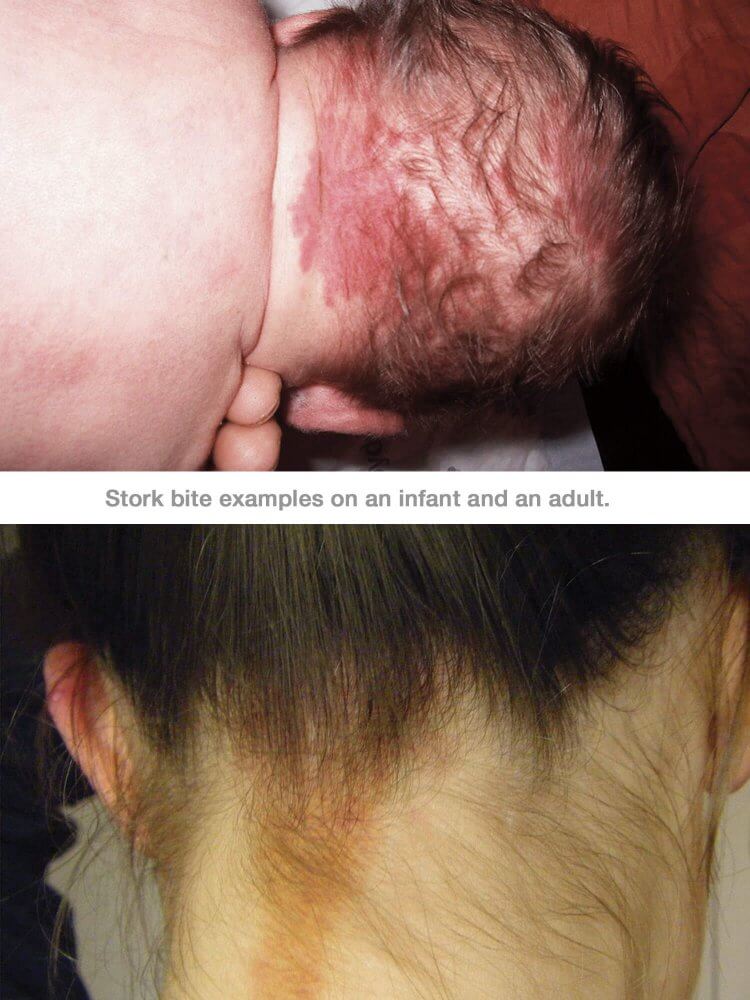 Stork Bite What You Need To Know About This Birthmark