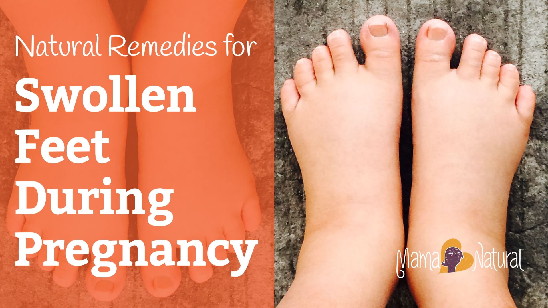 Swollen Feet During Pregnancy: Natural