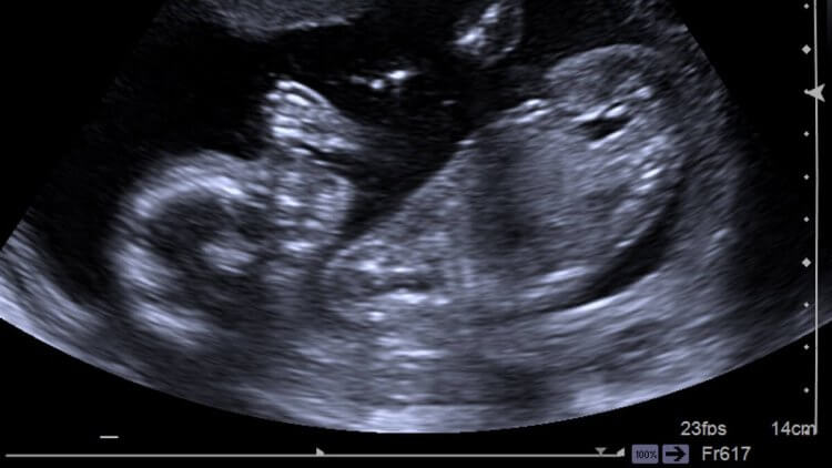 Baby Ultrasound Risks Vs Rewards Mama Natural