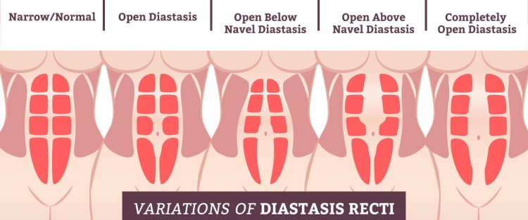 Các biến thể khác nhau và mức độ nghiêm trọng của Diastasis Recti