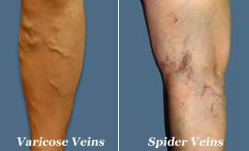 Varicose Veins What Are They (and What You Can Do About Them) - spider varicose