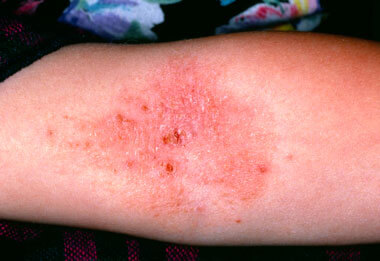 Bệnh chàm ở chân và tay ở trẻ em