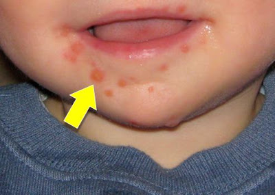 Child With Coxsackie Blisters Around Mouth