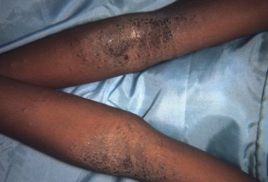 eczema on black and brown skin